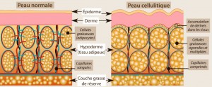 schema-definition-celullite-full-10523595